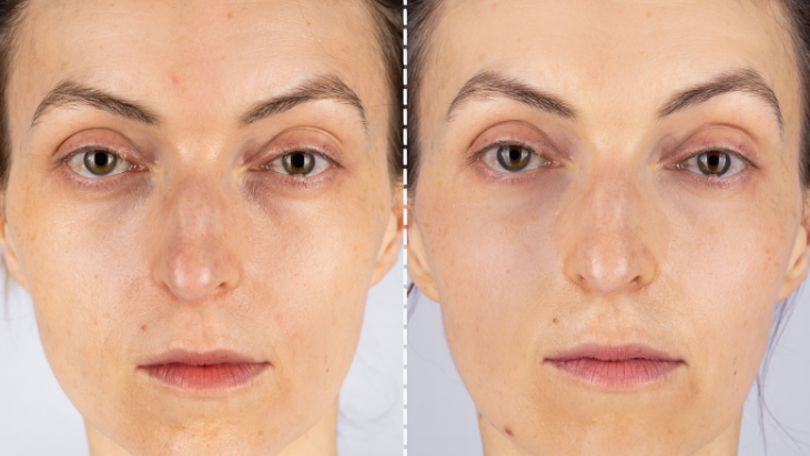 Before and After Images LED mask
