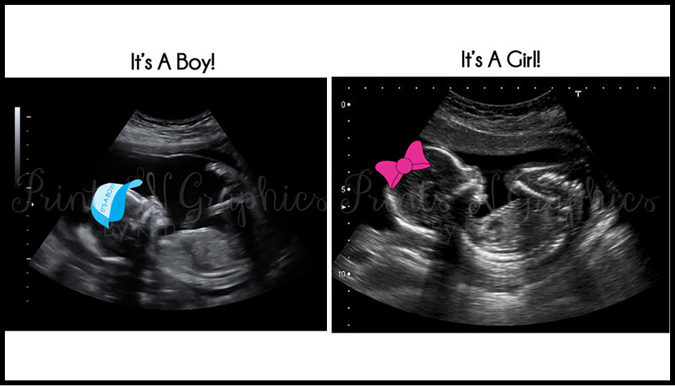 Customised Ultrasound Gender Reveal